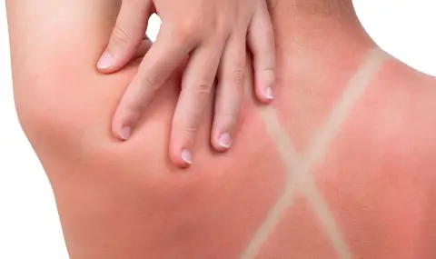 Най-големите грешки, които допускаме при слънчево изгаряне и как да ги избегнем